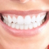 Отбеливание зубов – неожиданные заблуждения