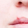 Герпес на губах: быстрое лечение современными препаратами и народными средствами